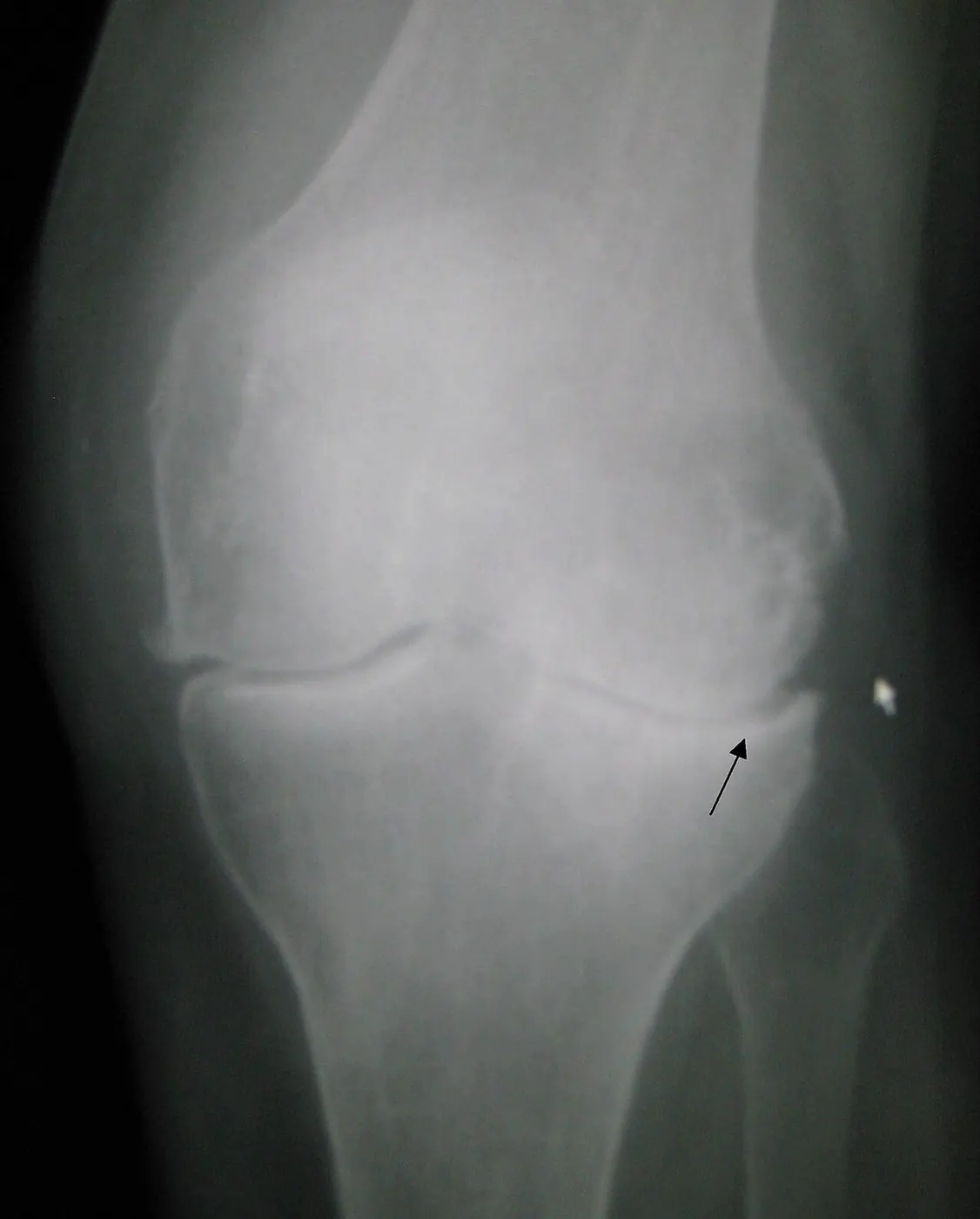 Radiographie d’un genou de face ; une flèche montre un interligne articulaire pincé.