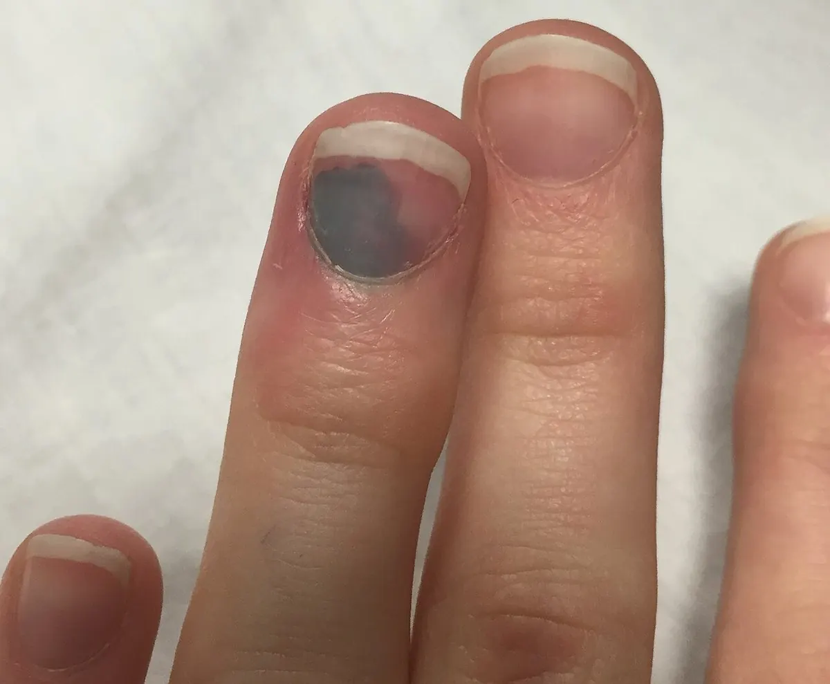 Doigt dont l’ongle présente une tache bleu-noir due à du sang accumulé dessous.