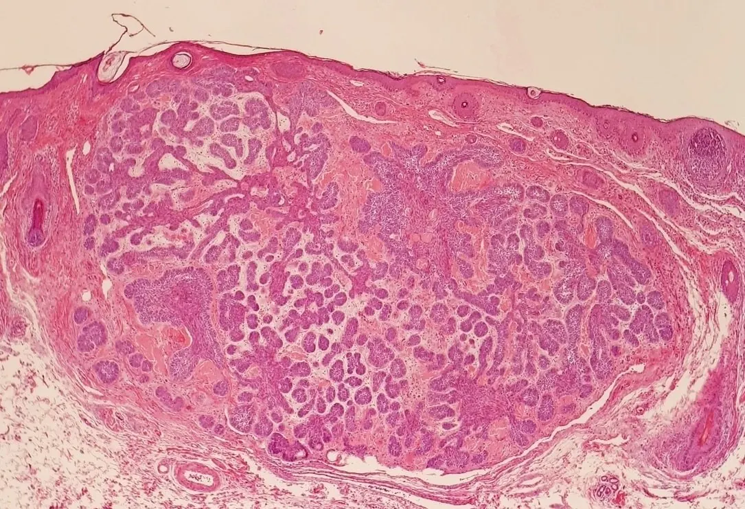 Coupe de peau colorée en rose et violet : sous l’épiderme, de nombreux petits amas de cellules tumorales violettes.