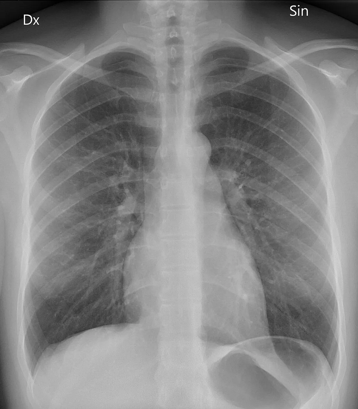 Radiographie du thorax de face : deux champs pulmonaires sombres, ombre du cœur au centre, côtes et coupoles diaphragmatiques.