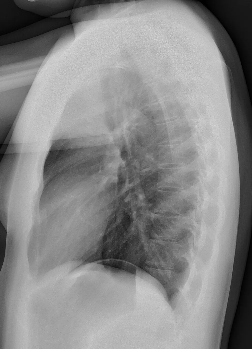 Radiographie du thorax de profil : colonne en arrière, ombre du cœur en avant, coupoles diaphragmatiques en bas.