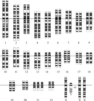 Schéma (idéogramme) des 23 paires de chromosomes avec trois exemplaires du chromosome 21 ; la dernière paire est XY ou XX.