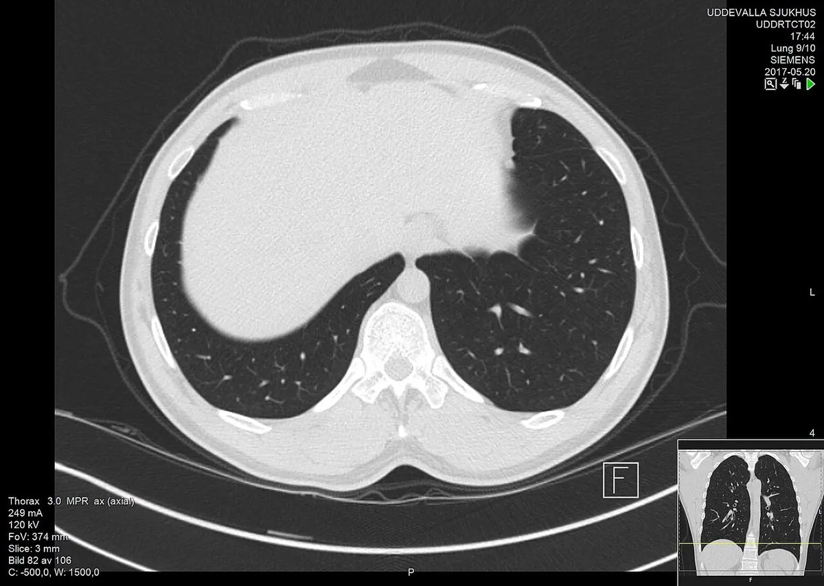 Coupe transversale basse du thorax en fenêtre pulmonaire : deux bases pulmonaires sombres de part et d’autre de la colonne, dôme du foie clair à gauche de l’image.